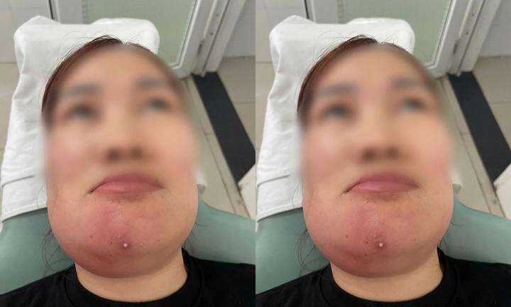 Tự ý nặn mụn tại nhà, người phụ nữ 37 tuổi phải nhập viện cấp cứu