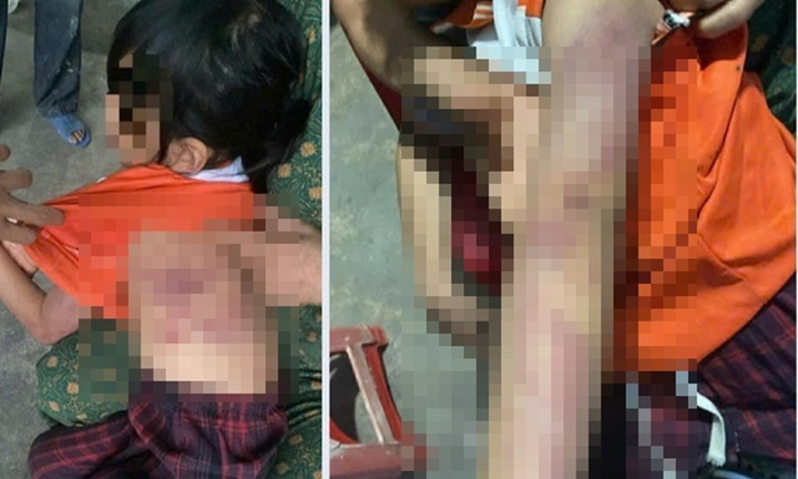 Vụ bé gái lớp 2 bị bạn đánh bầm tím người: Hiệu trưởng hé lộ nguyên nhân