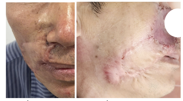 “Mổ đi mổ lại” vẫn tái phát: Bác sĩ cảnh báo ung thư da âm thầm xâm lấn