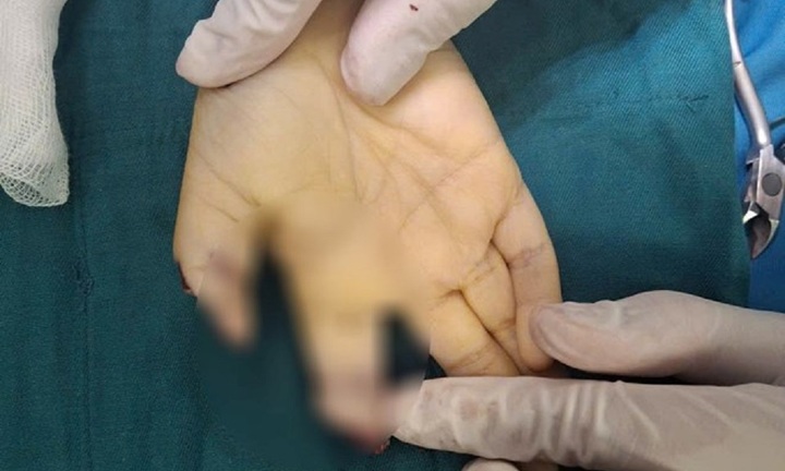 Vụ bé trai đứt lìa 2 ngón tay vì chơi xe điện tự chế: Bác sĩ chia sẻ điều đáng lo ngại