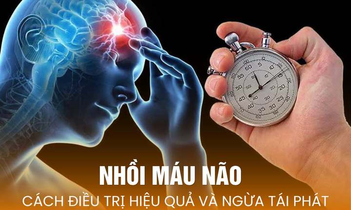 Nhồi máu não: Cách điều trị hiệu quả và ngừa tái phát