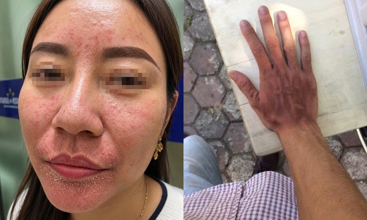 Gia tăng bệnh lý về da mùa nắng nóng: Bảo vệ thế nào cho đúng cách?