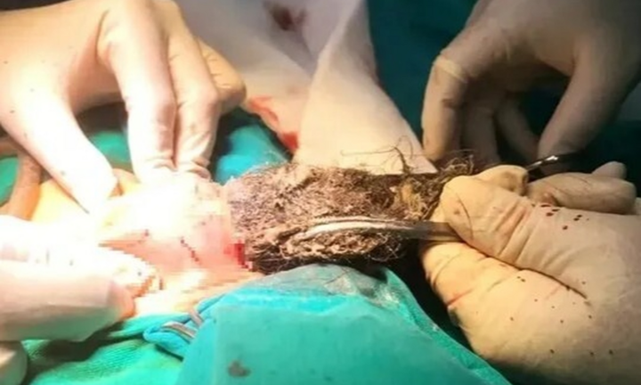 Bất ngờ với búi tóc dài gần 20cm cuộn chặt trong dạ dày bé 4 tuổi