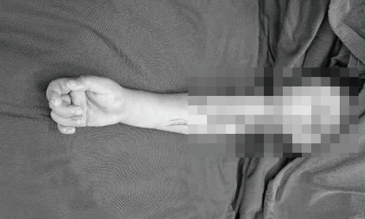 Bé gái 4 tuổi ở Tuyên Quang bị thương nặng vì áo chống nắng cuốn vào bánh xe