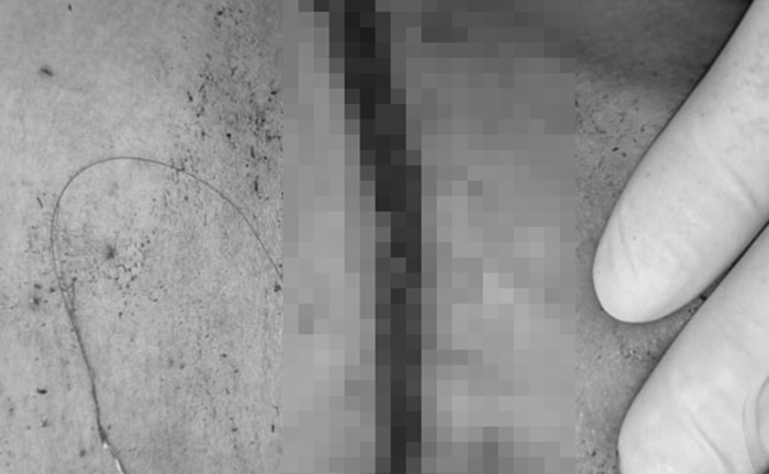 Đi leo núi, 2 người bị sét đánh: Một nạn nhân hôn mê sâu, phù não
