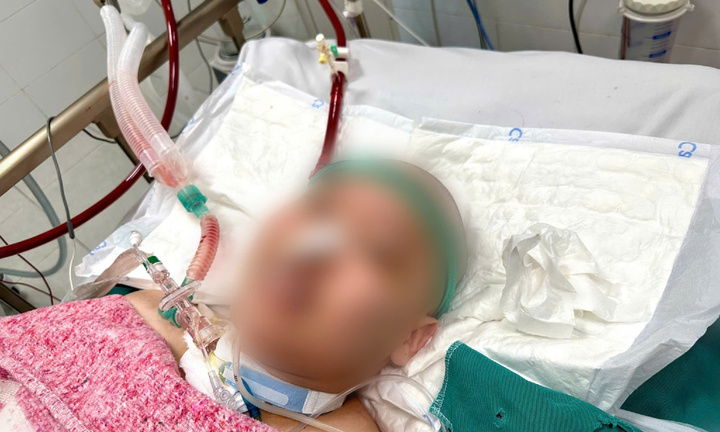 Nam bệnh nhân 25 tuổi suy đa tạng, nguy kịch được cứu sống nhờ ECMO