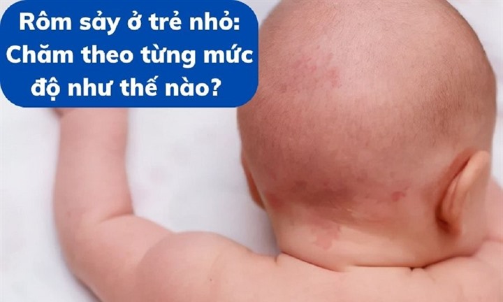 Rôm sảy ở trẻ nhỏ: Chăm theo từng mức độ như thế nào? 