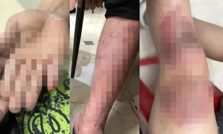 Bàn chân ngứa, đỏ sau khi lội nước ngập, dấu hiệu nào đáng lo?
