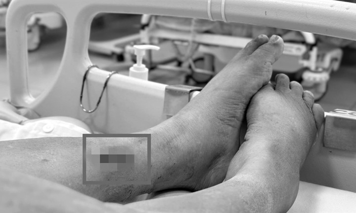 Người phụ nữ 2 lần nhập viện vì uốn ván do mảnh tre 3cm sót trong chân