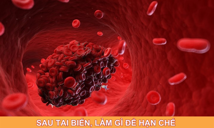 Sau tai biến, làm gì để hạn chế cục máu đông tái hình thành?