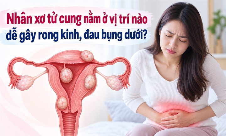 Nhân xơ tử cung nằm ở vị trí nào dễ gây rong kinh, đau bụng dưới?