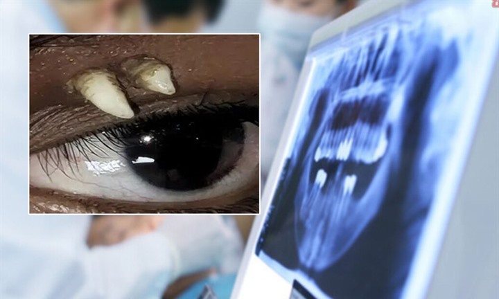 Thiếu nữ sưng húp mắt suốt nhiều tháng, bác sĩ rùng mình gắp ra thứ 