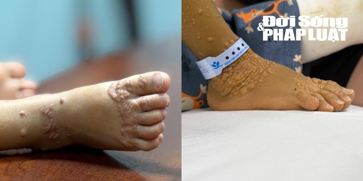 Nỗi đau của bệnh nhi mắc hội chứng Alagille: Cơ thể đầy u vàng ngứa ngáy, rào cản khi hòa nhập - 6