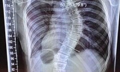 Xương sống thiếu nữ cong vì chiều cao tăng đột ngột