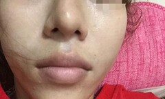 Ham rẻ tiêm chất làm đầy rởm: Hoại tử mũi, biến dạng cằm