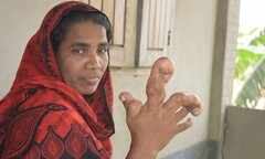 Người phụ nữ có bàn tay phải to lạ thường