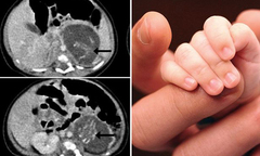 Chuyện lạ: Bé gái vừa chào đời đã “mang thai” một cặp song sinh