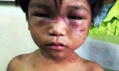 Bé trai 3 tuổi bị người thân tra tấn, bắt đi ăn xin