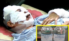 Chồng thuê người tạt axit vợ vì ghen tuông