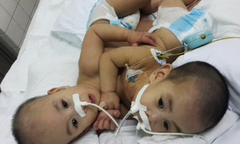 Tách rời hai bé trai dính nhau phức tạp