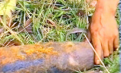 Đứt lìa cánh tay do cưa quả đạn pháo