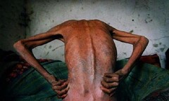 Xót xa hình ảnh cơ thể người khi chuyển sang giai đoạn AIDS