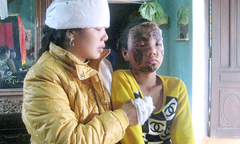  Vụ nổ quà sinh nhật: Mặt bé gái bị cháy xém