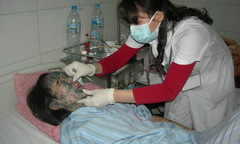 Bệnh thủy đậu bùng phát, hết vắc xin phòng bệnh