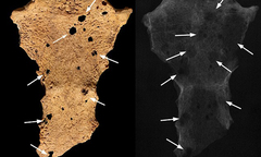 Người đầu tiên bị ung thư xuất hiện từ hơn 3.000 năm trước