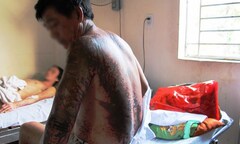 Bình Dương: 4 người bị tạt axit khi đang đi tập thể dục