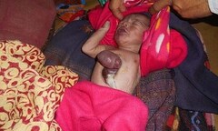 Xót lòng những bé sơ sinh có nội tạng ngoài cơ thể