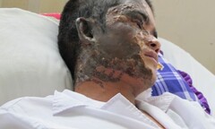 Bỗng dưng bị tạt axít lúc...đang ngủ