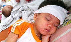 Trẻ nổ con ngươi vì bố mẹ chăm bệnh sởi sai cách