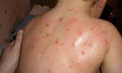 Bệnh tay chân miệng đã xuất hiện tại 62 tỉnh, thành