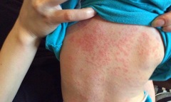 Đã có 130 trường hợp tử vong liên quan đển sởi