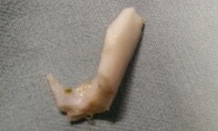 Bé trai một tuổi bị hóc xương lợn