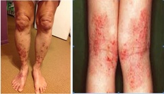 Chữa bệnh chàm nhanh nhất ở Bảo Thanh Đường