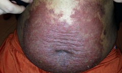 Hỏi đáp trị bệnh vẩy nến ở Bảo Thanh Đường