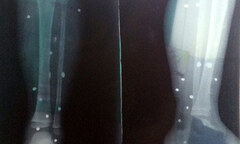 Côn đồ nổ súng, bé 4 tuổi  "dính " 15 viên đạn