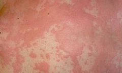 Hỏi đáp về bệnh dị ứng và cách chữa trị