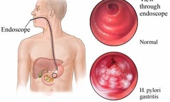 Viêm Loét Dạ Dày Tá Tràng – Với Phương Thuốc Hiệu Nghiệm