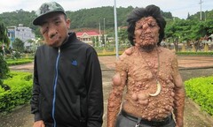 Đắk Lắk: 3 cha con mang  "khuôn mặt quỷ "