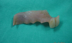 Ruột bị hoại tử vì... 2 cái răng giả