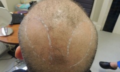 Dùng lông ngực cấy tóc cho nam giới bị hói