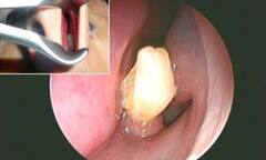 Răng mọc trong mũi nam thanh niên 22 tuổi