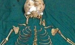 Chuyện lạ: Bào thai nằm suốt 36 năm trong bụng mẹ