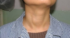 Hỏi và đáp về bệnh lý tuyến giáp