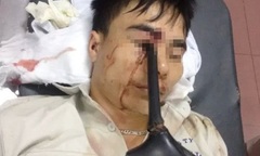 Cầm ô đi xe máy, thanh niên bị cán gương đâm xuyên mắt
