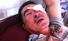 Hành khách bị ném đá trên QL 14 bị hỏng hoàn toàn mắt trái