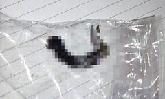 Đỉa sống ký sinh hơn 1 tháng trong thanh quản bé 11 tuổi